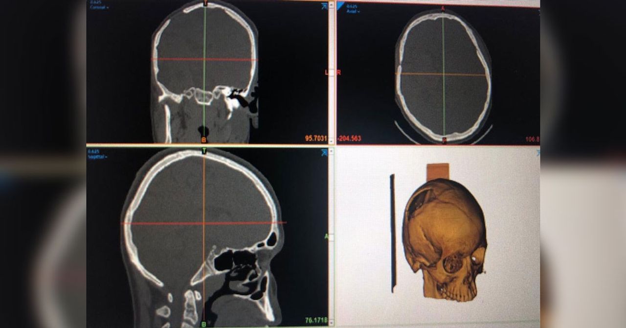 3 boyutlu yazıcıdan kemik implantı yapıldı 3 boyutlu yazıcıdan kemik implantı yapıldı
