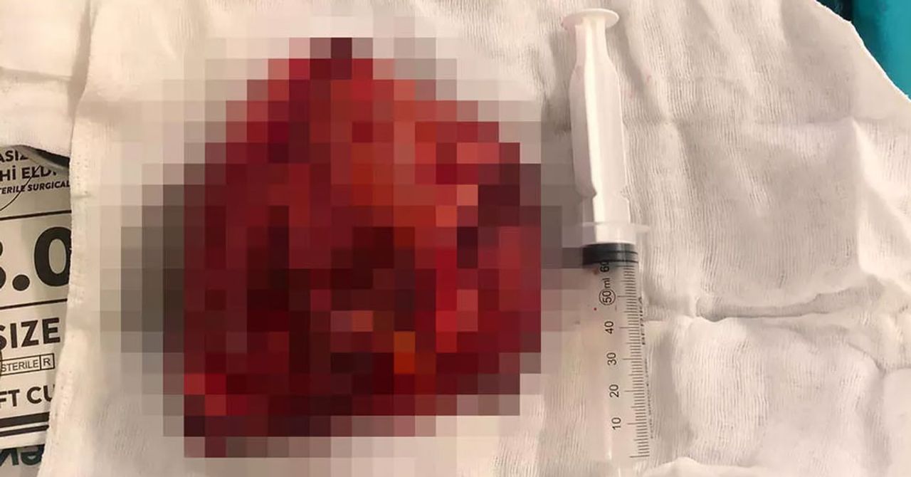 5 Saat Ameliyat Masasında Kaldı! 5 Saat Ameliyat Masasında Kaldı!