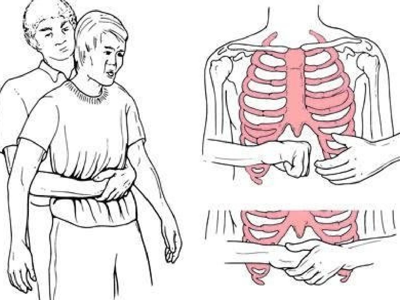 Heimlich manevrası nasıl yapılır? Heimlich manevrası nasıl yapılır?