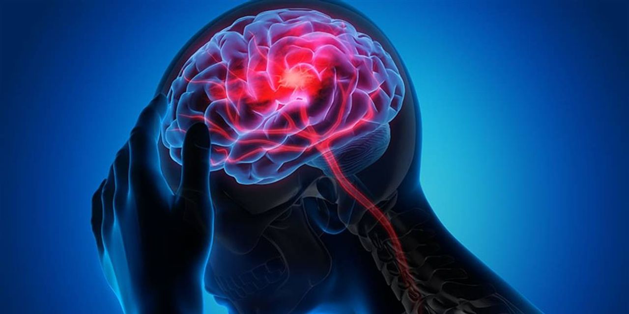 Beyinde Pıhtı Atması Nedir Beyinde Pıhtı Atması Nedir
