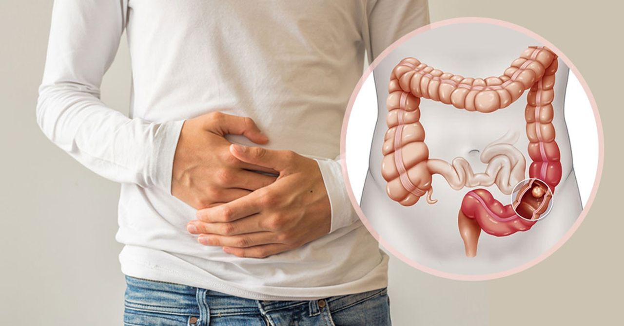 kolon kanserini tetikleyen durumlar kolon kanserini tetikleyen durumlar