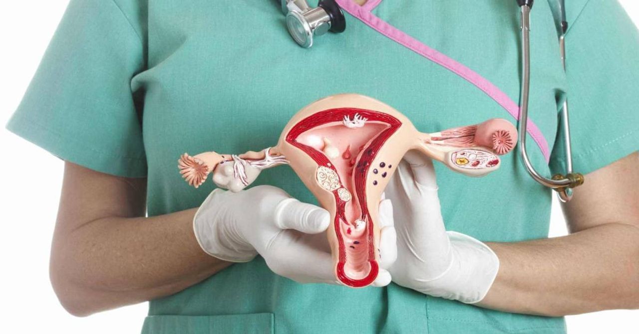 Endometriozis nedir, neden olur? Çikolata kisti nasıl geçer, patlarsa ne olur? Çikolata kisti belirtileri ve tedavileri Endometriozis nedir, neden olur? Çikolata kisti nasıl geçer, patlarsa ne olur? Çikolata kisti belirtileri ve tedavileri