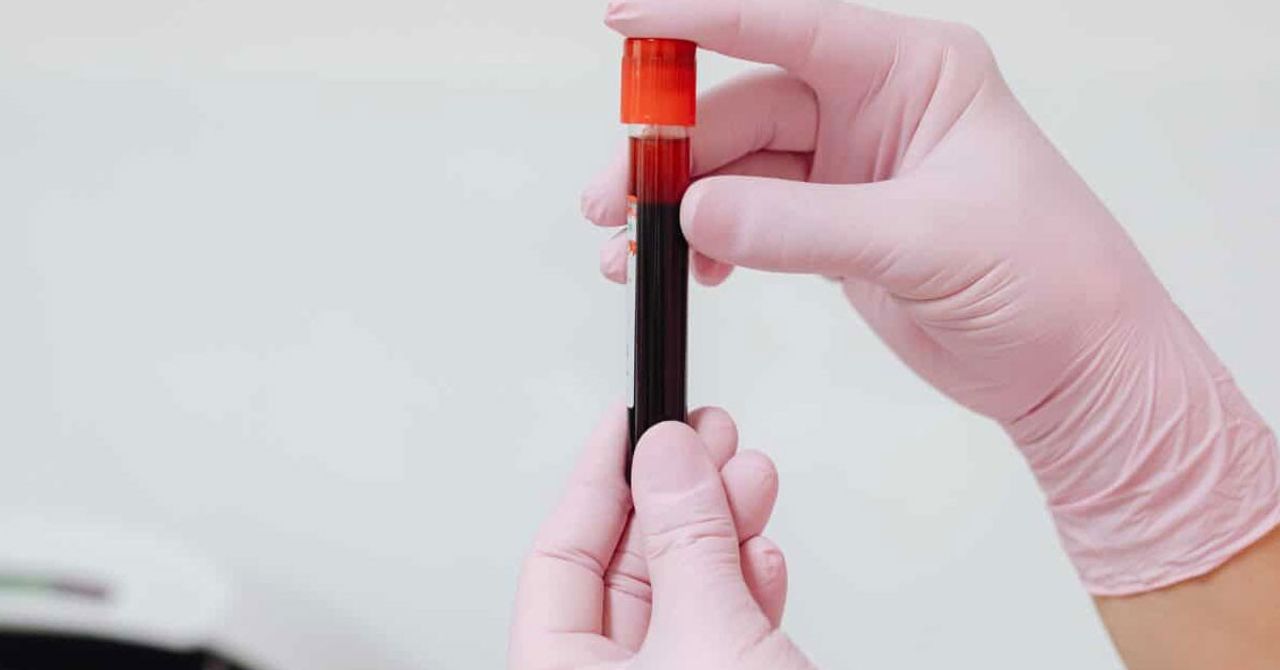 Genetik bir rahatsızlık olan hemofili hastalığına sahip bireylerin yaşam kalitesinin iyileşmesi adına Trakya Üniversitesi Tıp Fakültesi İç Hastalıkları ve Hematoloji Bilim Dalı Öğretim Üyesi Prof. Dr. Ahmet Muzaffer Demir, bakım ve tedavide çeşitli gelişmelerin yaşandığını fakat hala birçok karşılanmamış ihtiyacın olduğunun altını çizdi. Genetik bir rahatsızlık olan hemofili hastalığına sahip bireylerin yaşam kalitesinin iyileşmesi adına Trakya Üniversitesi Tıp Fakültesi İç Hastalıkları ve Hematoloji Bilim Dalı Öğretim Üyesi Prof. Dr. Ahmet Muzaffer Demir, bakım ve tedavide çeşitli gelişmelerin yaşandığını fakat hala birçok karşılanmamış ihtiyacın olduğunun altını çizdi.