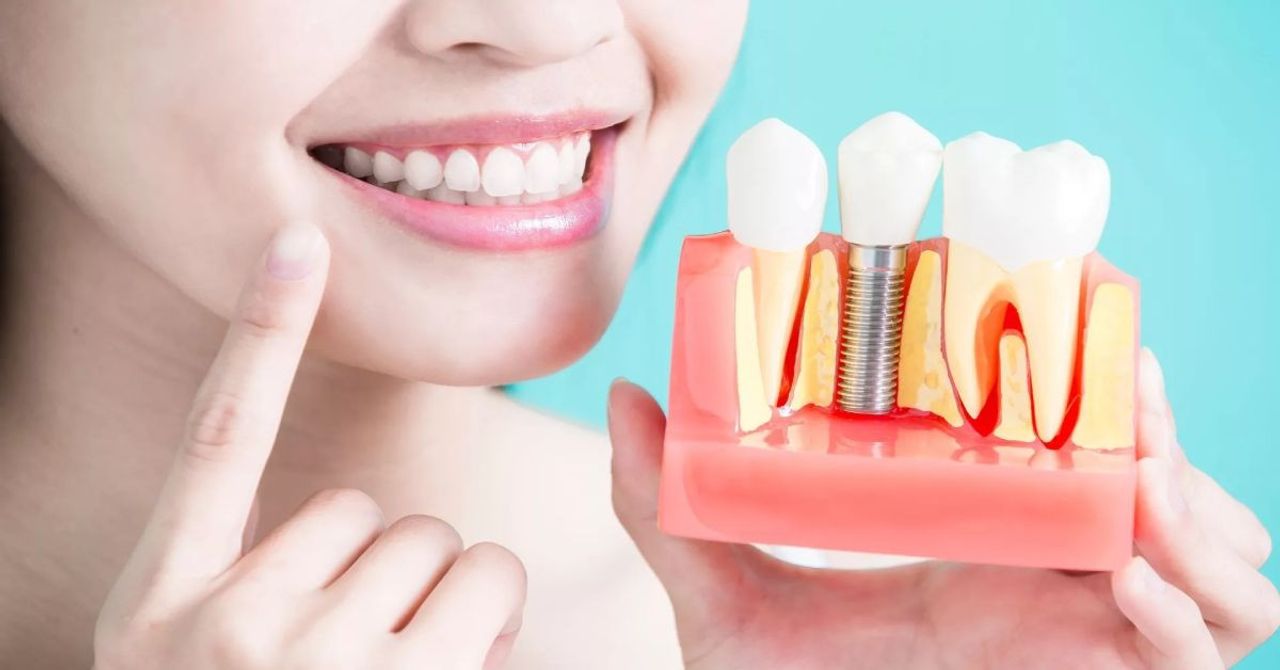İmplant nedir? Diş implant tedavisi kimlere nasıl uygulanır? İmplant nedir? Diş implant tedavisi kimlere nasıl uygulanır?