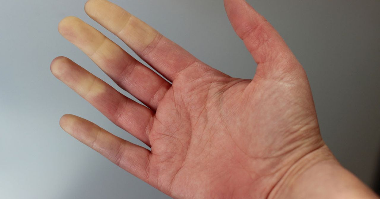 Raynaud Hastalığı Raynaud Hastalığı