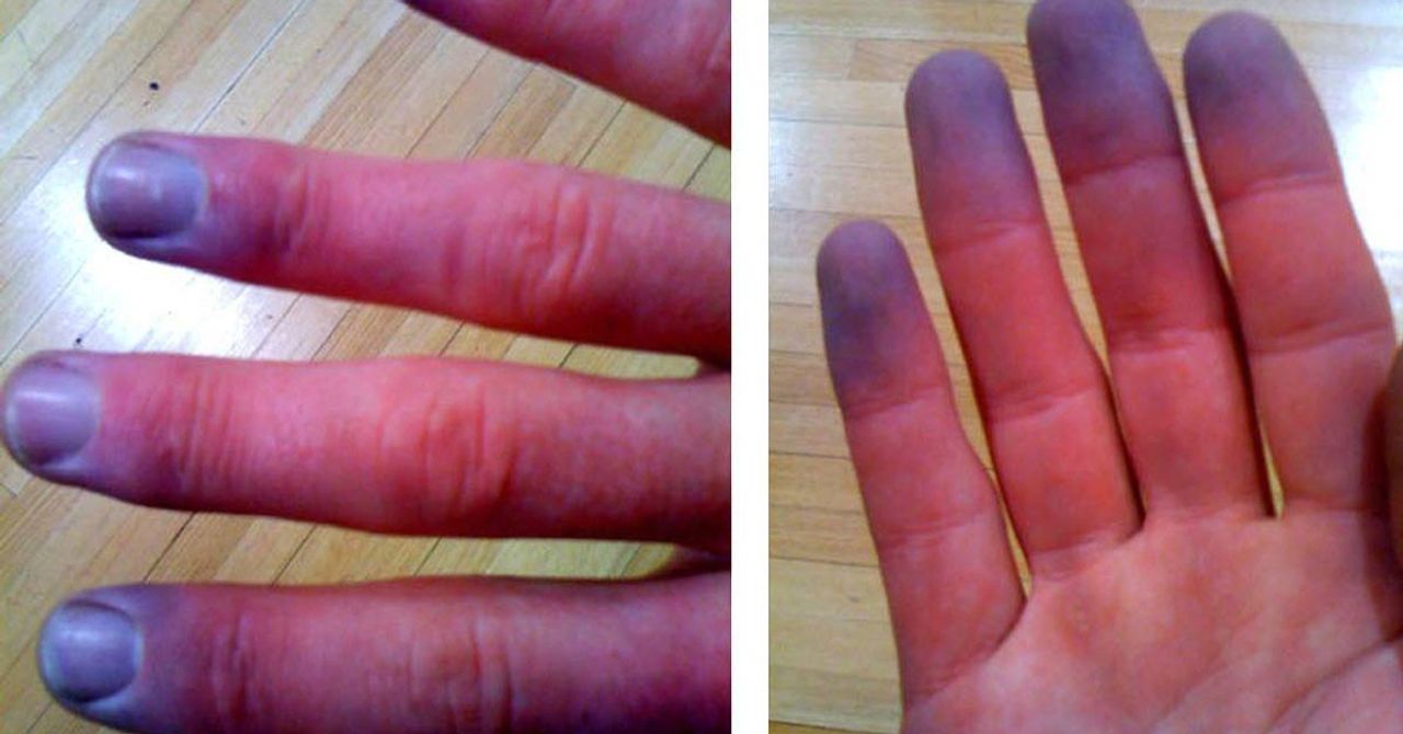 Raynaud Hastalığı Raynaud Hastalığı