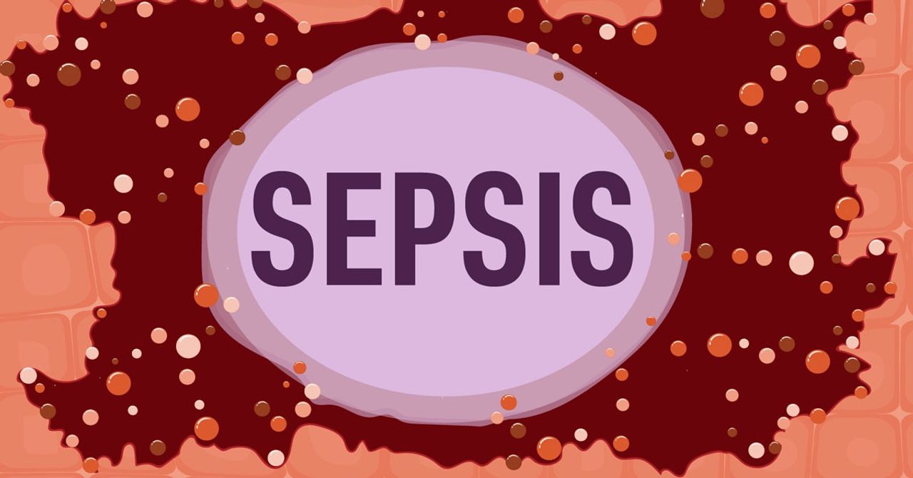 Sepsis kadını canından etti Sepsis kadını canından etti