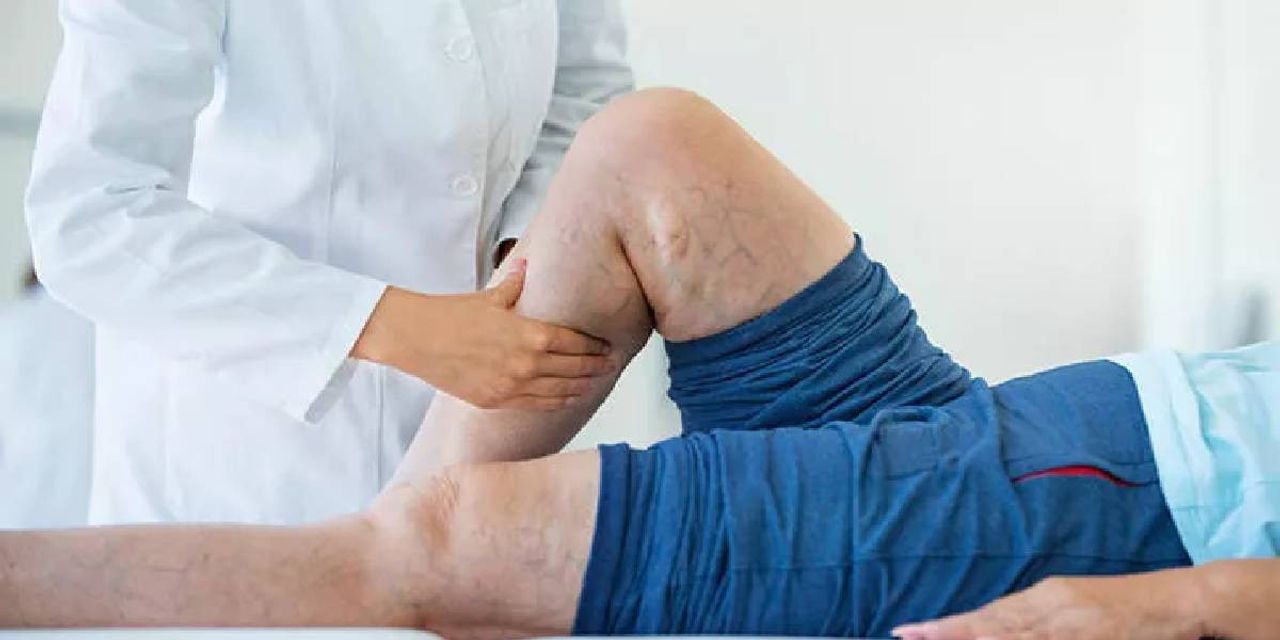 Varikosel Nedir Varikosel Nedir
