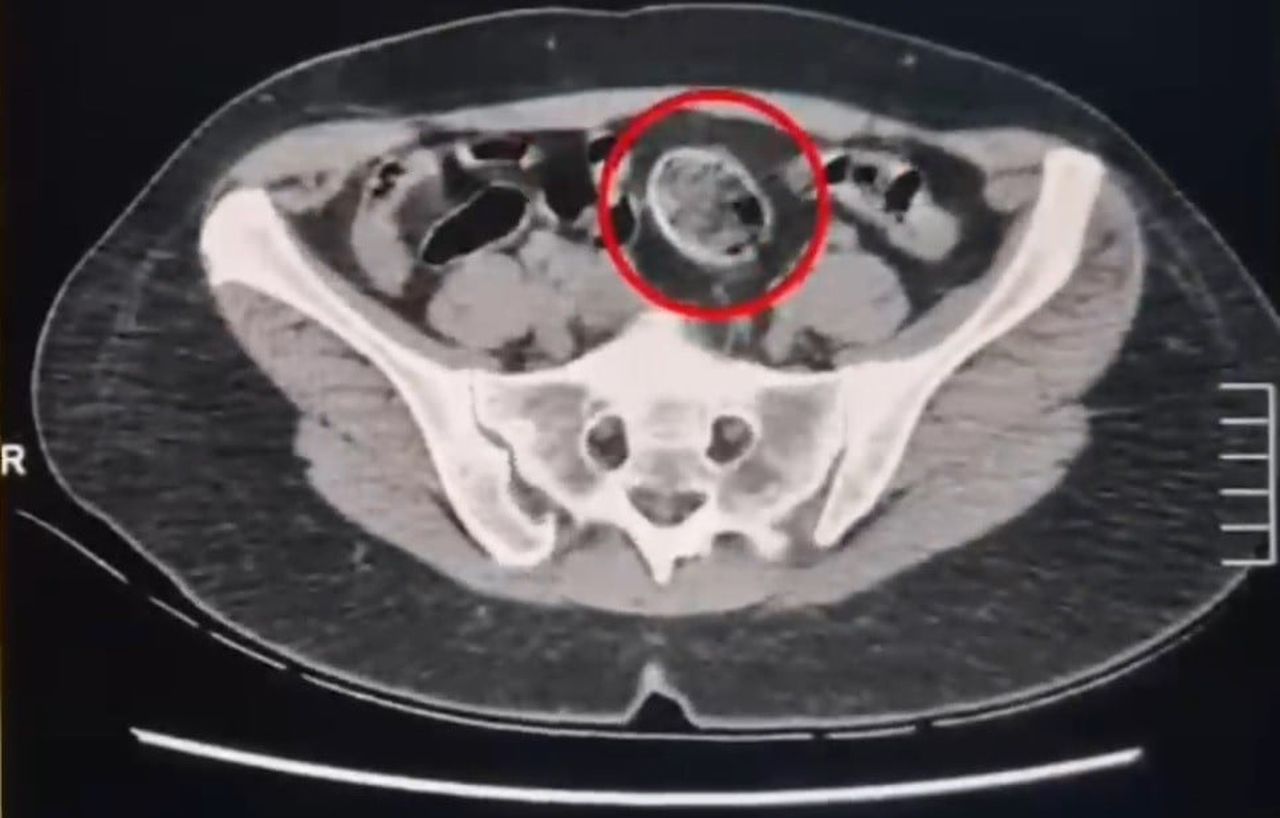 PAKET YAPIP MAKATINDAN VÜCUDUNA YERLEŞTİRDİKLERİ UYUŞTURUCULARI GÜMRÜKTEN GEÇİREMEDİLER.