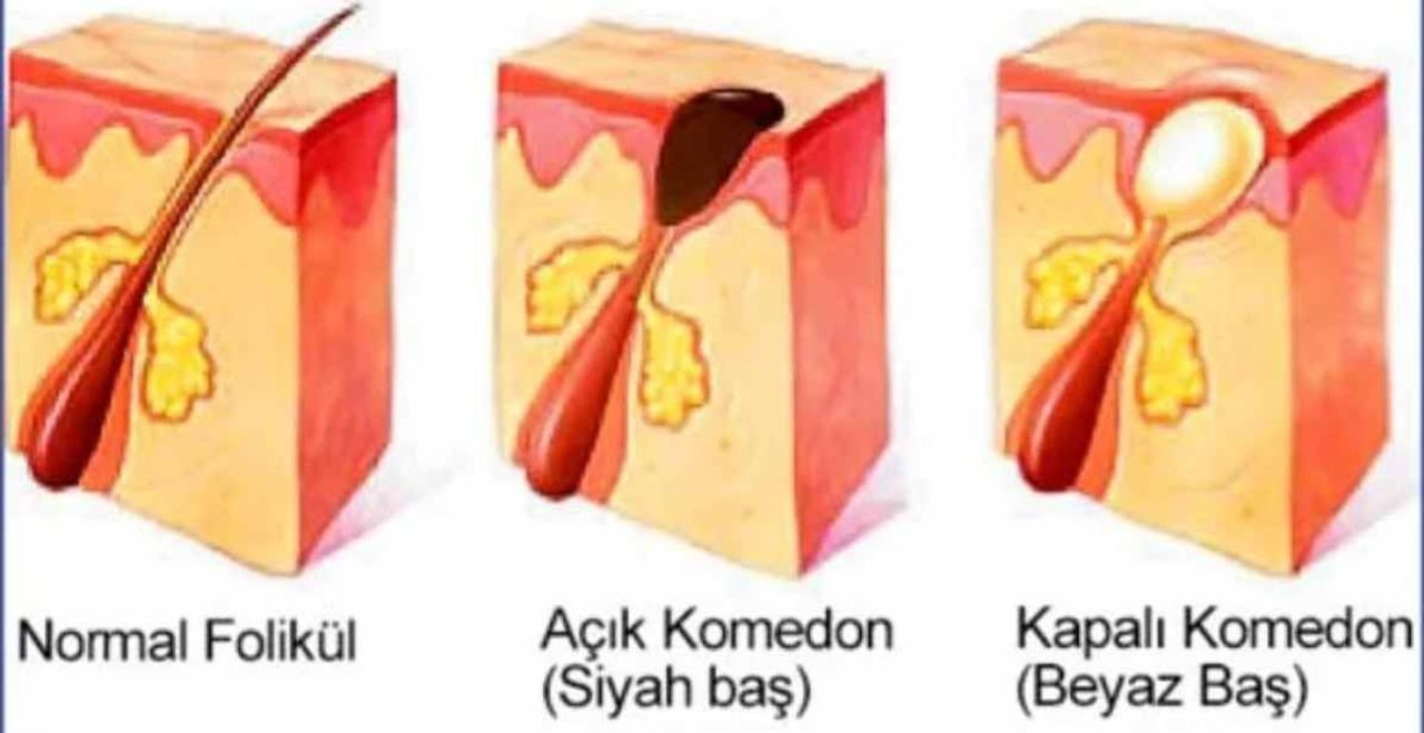 Sivilceyi sıktıktan sonra çıkan beyaz sıvının adı nedir