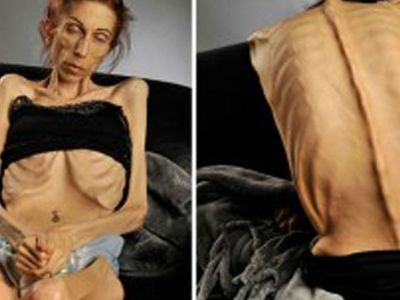 Anoreksiyaya yakalanan genç kadın 18 kiloya düşmüştü! Şimdi ki hali görenleri şaşırttı