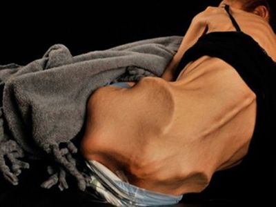 18 Kiloya Kadar Düşmüştü! Son Halini Görenler İnanamıyor!