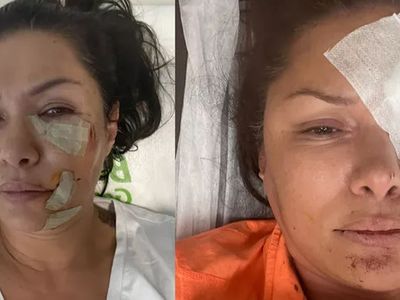 Şarkıcı Tuğba Altıntop'tan kötü haber! Köpek saldırısına uğradı: Son hali sevenlerini üzdü