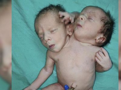 Hindistan’da doğum yapan anneye büyük şok! İkiz bekliyordu ama gerçek…