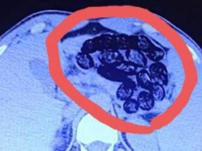 2 İran Uyruklu Şahsın Midesinden 103 Kapsül Metamfetamin Maddesi Bulundu