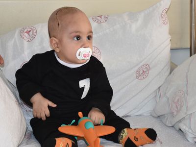 7 aylık bebeğin kafatasındaki şekil bozukluğu ameliyatla düzeltildi!