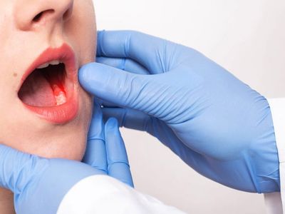 Ağız kanseri nedir, belirtileri nelerdir? Ağız içerisindeki iyileşmeyen yaralar ağzı kanserinin habercisi