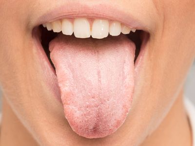 Ağız kuruluğu nedir, neden olur, belirtileri nelerdir, nasıl tedavi edilir? Ağız kuruluğu o hastalıkların habercisi