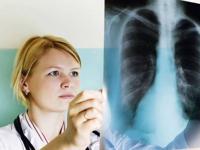 Akciğer kanserinin belirtileri nelerdir? Ciğerlerde ağrı kansere mi işaret? Akciğer kanseri nedir ve tedavisi nasıl yapılır?