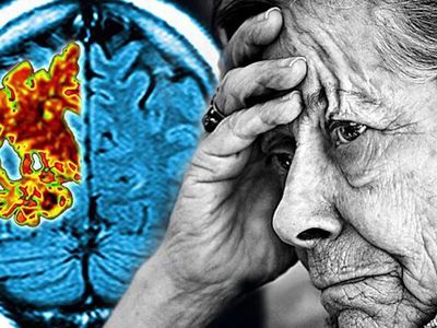 Alzheimer hastalığı artık tarihe karışıyor! Hastalara tünelin ucunda ışık göründü!