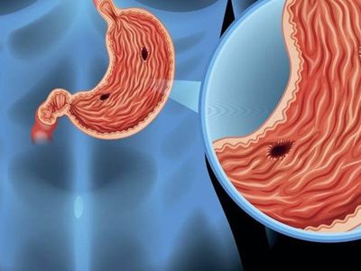 Antral Gastrit Nedir?