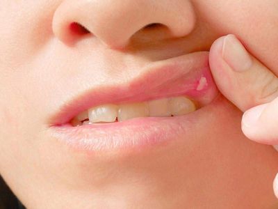 Behçet hastalığı nedir, belirtileri nelerdir, kendiliğinden geçer mi, bulaşıcı mıdır, tedavisi var mı? Körlüğe yol açan Behçet hastalığıyla ilgili bilinmesi gerekenler