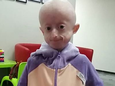 Benjamin Button Hikayesi Gerçek Oldu! 10 Yaşındaki Çocuk Yaşlılıktan Öldü