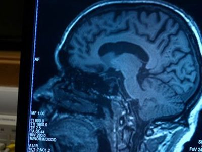 Bir Hastalığın Daha Çaresi Bulundu! Bilim insanları Alzheimer'ı Durdurmanın Yöntemini Açıkladı