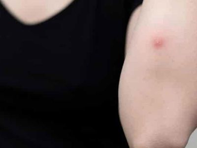 Bu bölgede çıkan çıbana dikkat! Ciddi hastalık habercisi olabilir 