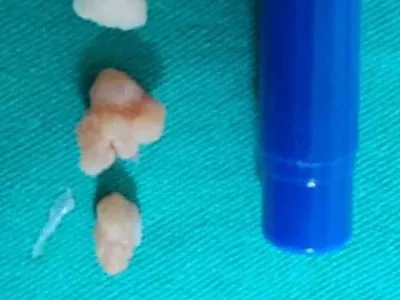 Patnos'ta dirsek artroskopisi ile sağlıklarına kavuşuyorlar