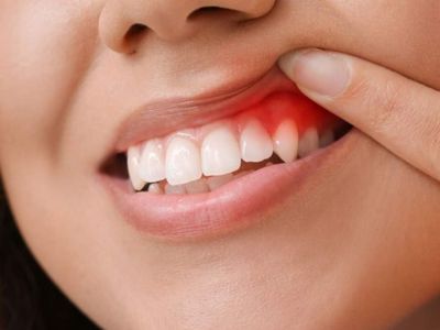 Diş eti iltihabı neden oluşur? Diş eti iltihabına iyi gelen besinler ve tedavisi