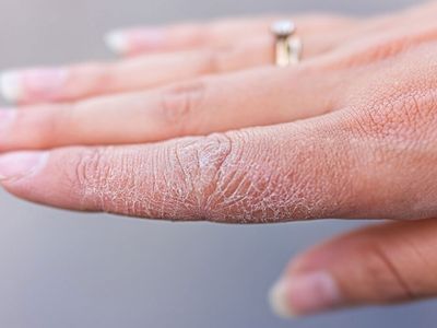 Egzamada nelere dikkat edilmeli, egzamaya hangi yağ iyi gelir? Egzamayı geçirecek doğal yöntemler 