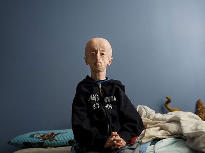 Erken Yaşlanma Hastalığı Progeria Nedir, Belirtileri Neler?