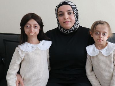 Yalova'da erken yaşlanma hastası olan iki kardeşin yaşam öyküsü!