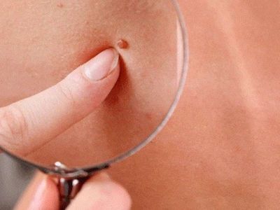 Et beni nedir, nasıl düşürülür? Et benlerini döken evde hazırlayabileceğiniz doğal tarifler
