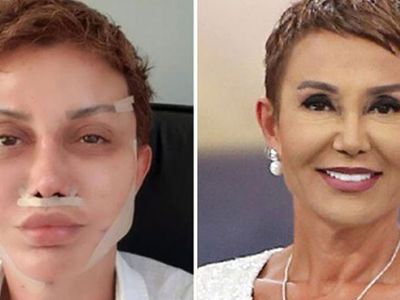 Fransız Askısı Yaptıran Serap Paköz Bandajları Çıkardı! Son Halini Sosyal Medyadan Paylaştı