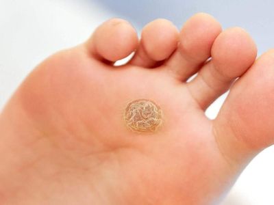 Genital siğil nedir, nasıl oluşur? 2022 Genital siğil tedavi yöntemleri