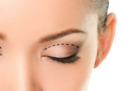 Göz kapağı düşüklüğü neden olur?  Göz kapağı düşüklüne neler iyi gelir? Göz kapağı düşüklüğünden bu tedaviyle kurtulabilirsiniz