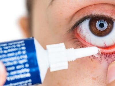 Göz Nezlesi (Konjuktivit) Nedir?