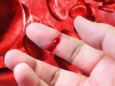 Hemofili hastalığı tedavi yönteminde dikkat edilmesi gereken yöntemler!