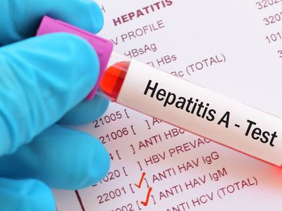 Hepatit A Neden Olur, Nasıl Geçer?