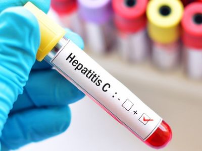 Hepatit C nedir, nasıl bulaşır, aşısı var mı? Hepatit C'den korunma yolları