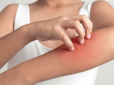 Hindi eti alerji yapar mı? Belirtileri nelerdir?