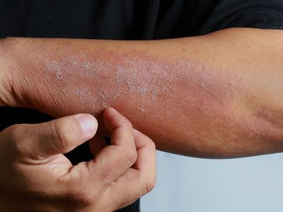 Mevsim Geçişlerinde Artan Alerjik Egzama Nasıl Önlenir?