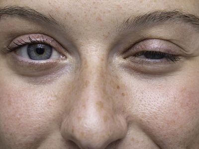 Myasthenia Gravis Nedir?