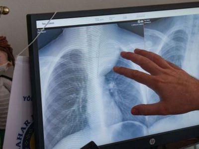 Nefes darlığı şikayetiyle hastaneye götürülmüştü: Çocuğun göğüs boşluğundan çıkan şey şok etti