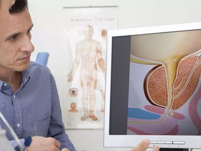 Prostat Kanseri Nedir, Belirtileri Nelerdir?