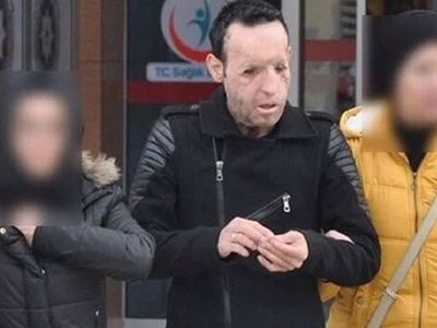 Recep Sert kimdir, tutuklandı mı? Yüz nakli yapılan Recep Sert hakkında bilgiler
