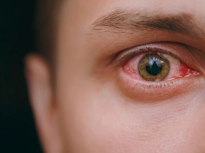 Retina Yırtılması Nedir, Retina Yırtılması Nasıl Tedavi Edilir?
