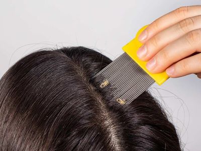 Saç kaşıntısı neden olur? Saç kaşıntısı nasıl geçer? Saç kaşıntısı  için evde doğal tedavi yöntemleri